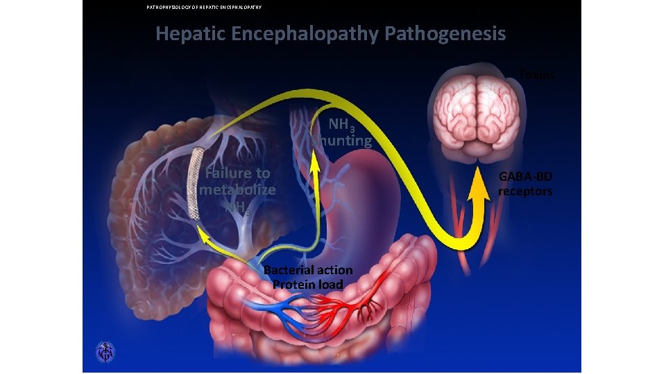 PATHOPHYSIOLOGY OF HEPATIC ENCEPHALOPATHY Hepatic Encephalopathy Pathogenesis Toxins NH 3 Shunting Failure to metabolize