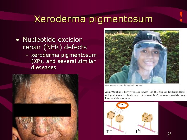 ! Xeroderma pigmentosum • Nucleotide excision repair (NER) defects – xeroderma pigmentosum (XP), and