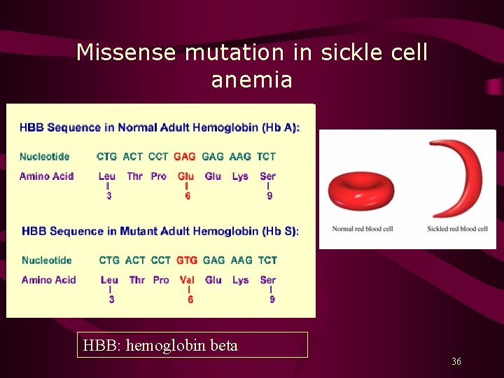 Missense mutation in sickle cell anemia HBB: hemoglobin beta 36 