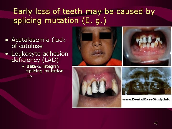 Early loss of teeth may be caused by splicing mutation (E. g. ) •
