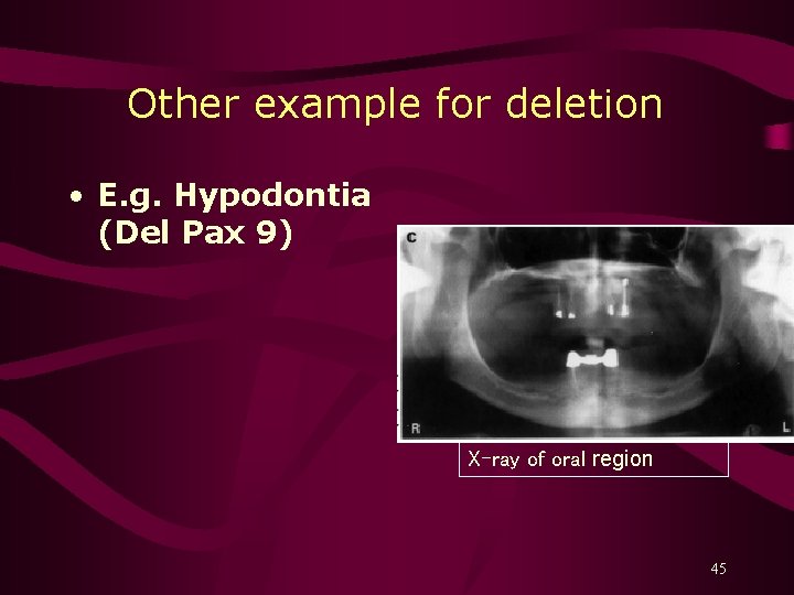 Other example for deletion • E. g. Hypodontia (Del Pax 9) X-ray of oral