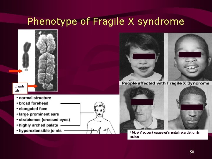 Phenotype of Fragile X syndrome Fragile site * Most frequent cause of mental retardation