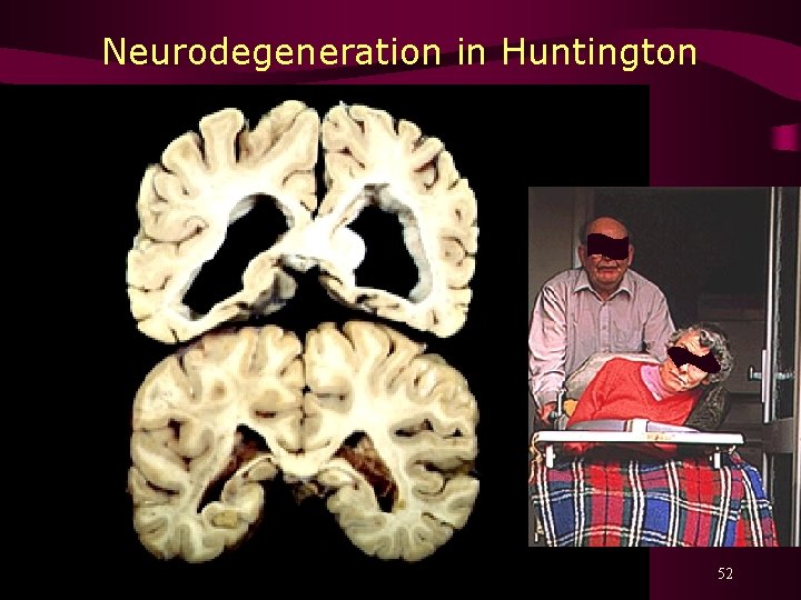 Neurodegeneration in Huntington 52 