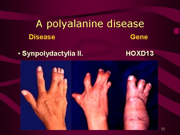 A polyalanine disease Disease • Synpolydactylia II. Gene HOXD 13 53 