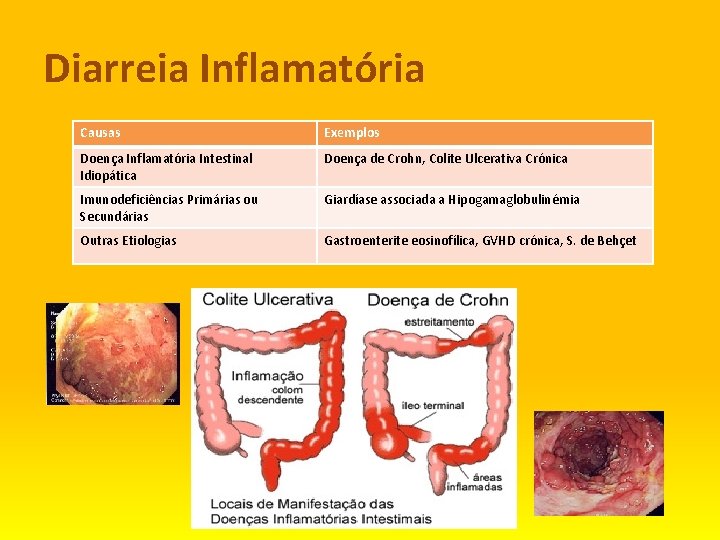 Diarreia Inflamatória Causas Exemplos Doença Inflamatória Intestinal Idiopática Doença de Crohn, Colite Ulcerativa Crónica