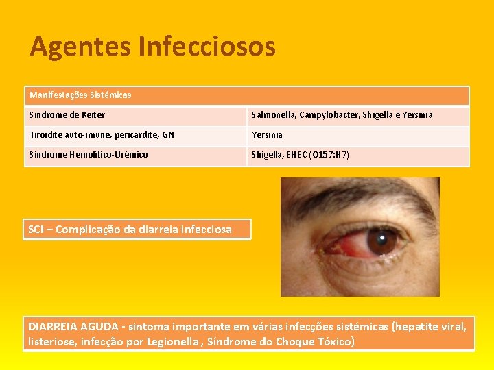 Agentes Infecciosos Manifestações Sistémicas Síndrome de Reiter Salmonella, Campylobacter, Shigella e Yersinia Tiroidite auto-imune,