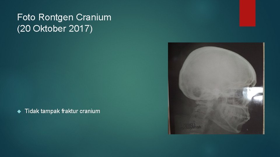 Foto Rontgen Cranium (20 Oktober 2017) Tidak tampak fraktur cranium 