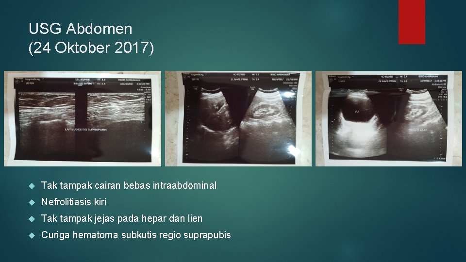 USG Abdomen (24 Oktober 2017) Tak tampak cairan bebas intraabdominal Nefrolitiasis kiri Tak tampak