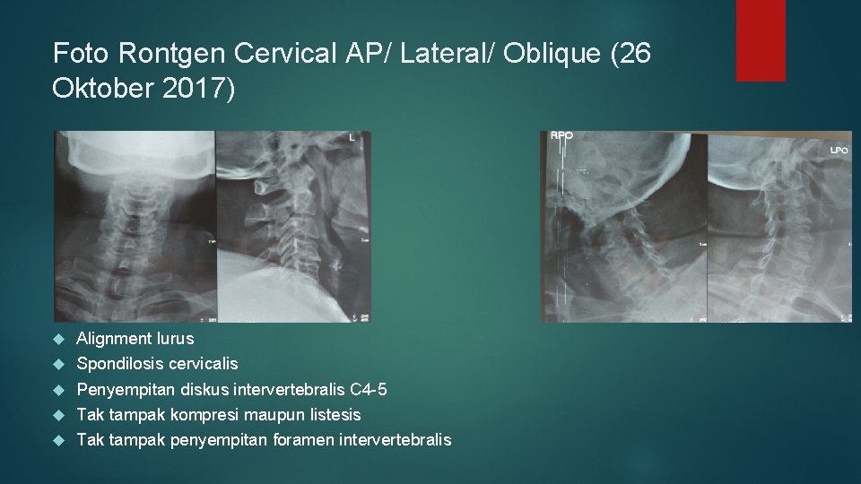 Foto Rontgen Cervical AP/ Lateral/ Oblique (26 Oktober 2017) Alignment lurus Spondilosis cervicalis Penyempitan