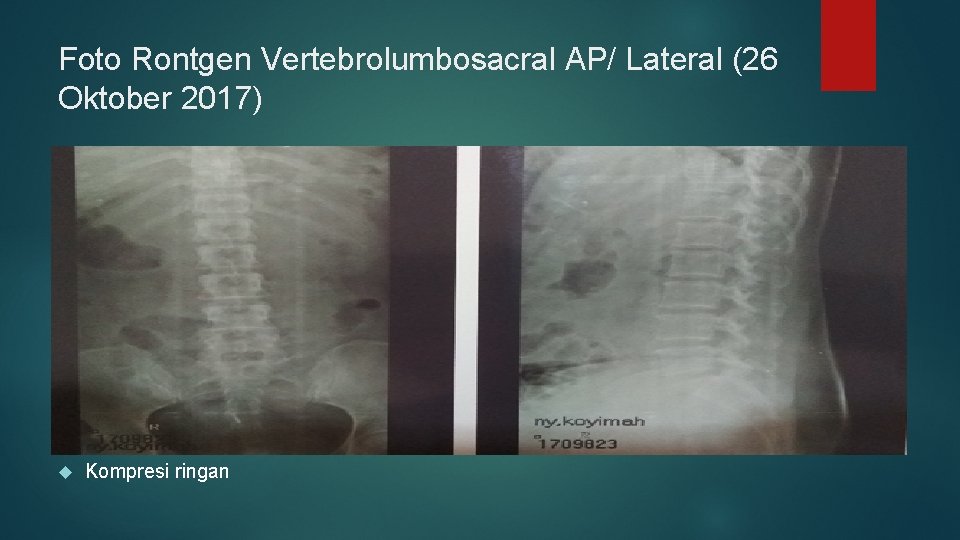 Foto Rontgen Vertebrolumbosacral AP/ Lateral (26 Oktober 2017) Kompresi ringan 