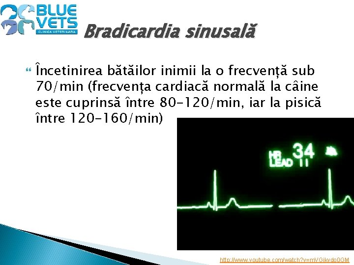 Bradicardia sinusală Încetinirea bătăilor inimii la o frecvență sub 70/min (frecvența cardiacă normală la