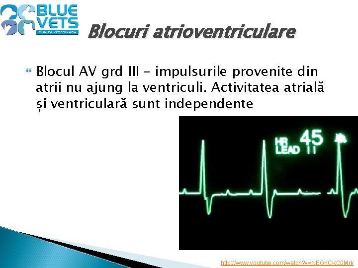 Blocuri atrioventriculare Blocul AV grd III – impulsurile provenite din atrii nu ajung la