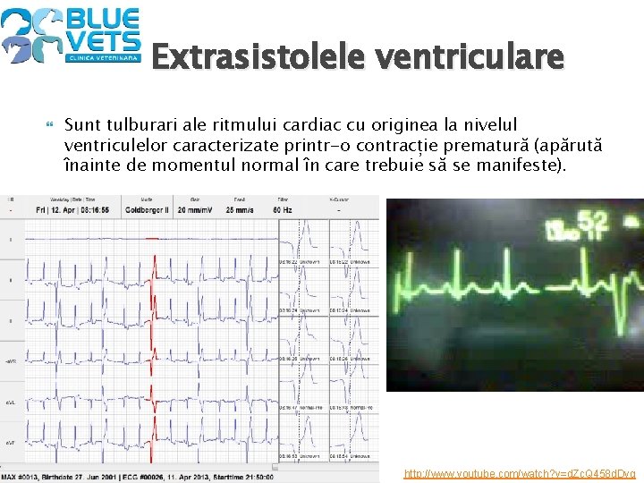 Extrasistolele ventriculare Sunt tulburari ale ritmului cardiac cu originea la nivelul ventriculelor caracterizate printr-o