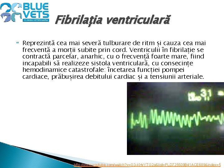 Fibrilația ventriculară Reprezintă cea mai severă tulburare de ritm și cauza cea mai frecventă