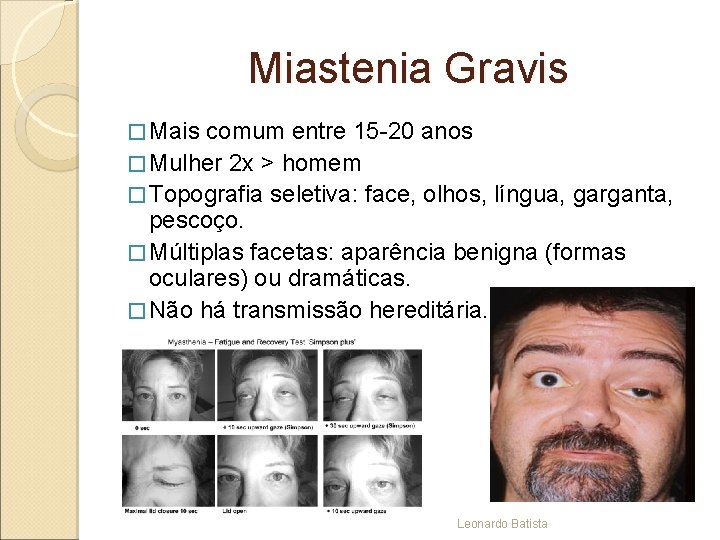 Miastenia Gravis � Mais comum entre 15 -20 anos � Mulher 2 x >