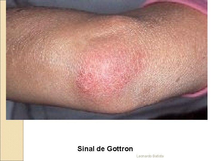 Sinal de Gottron Leonardo Batista 