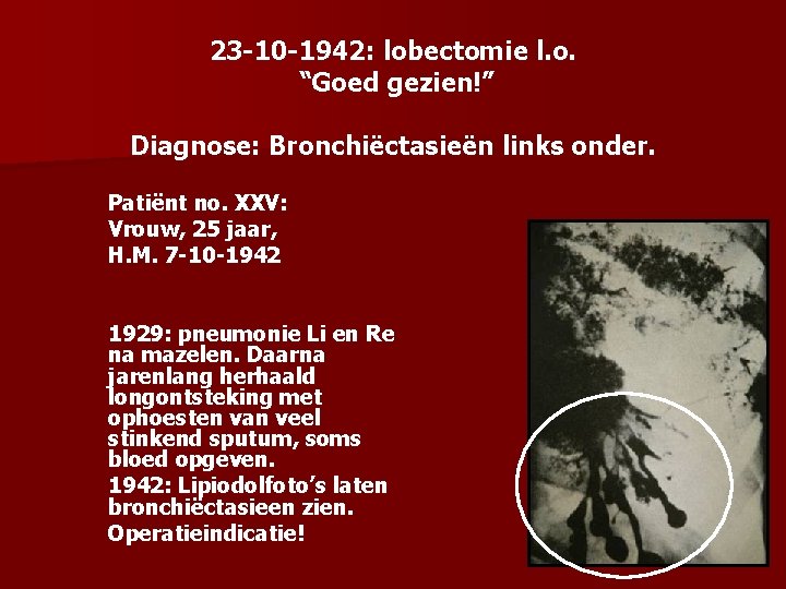 23 -10 -1942: lobectomie l. o. “Goed gezien!” Diagnose: Bronchiëctasieën links onder. Patiënt no.