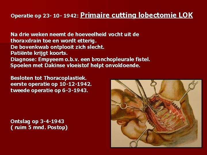 Operatie op 23 - 10 - 1942: Primaire cutting lobectomie LOK Na drie weken