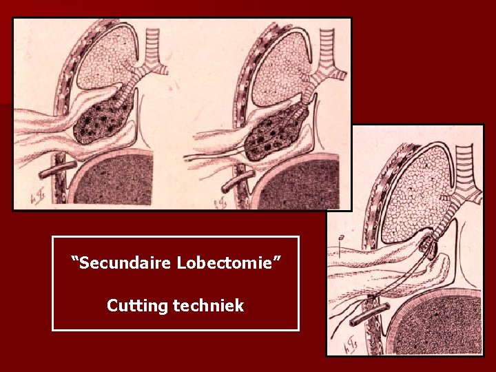 “Secundaire Lobectomie” Cutting techniek 