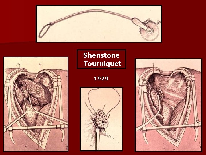 Shenstone Tourniquet 1929 