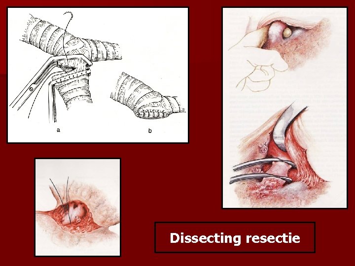 Dissecting resectie 