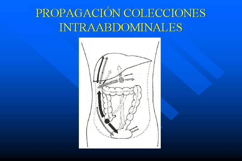 PROPAGACIÓN COLECCIONES INTRAABDOMINALES 