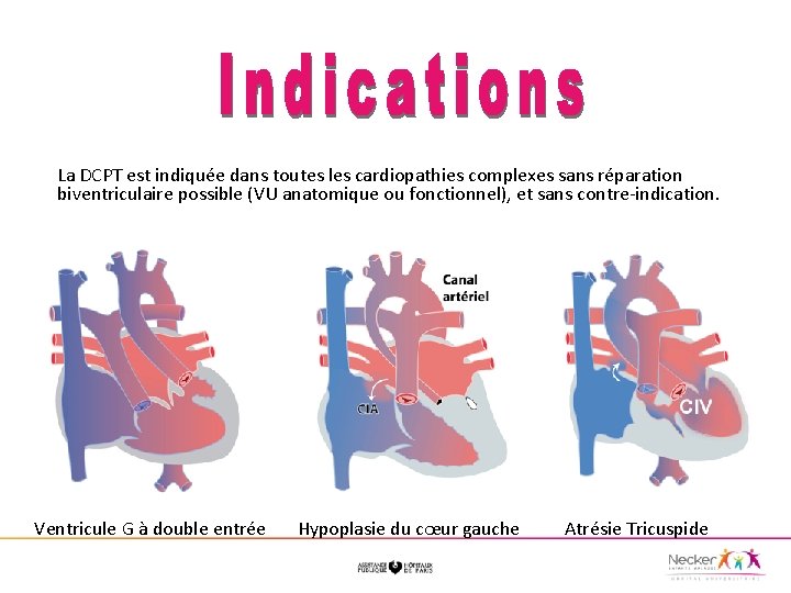 La DCPT est indiquée dans toutes les cardiopathies complexes sans réparation biventriculaire possible (VU