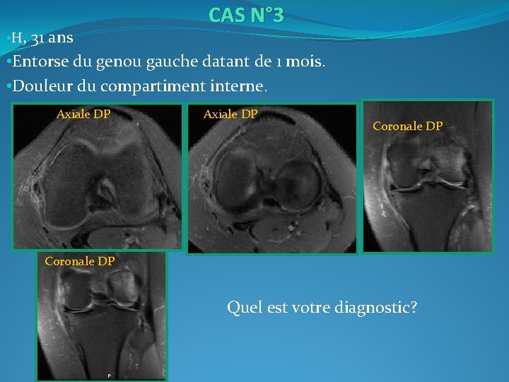  • H, 31 ans CAS N° 3 • Entorse du genou gauche datant