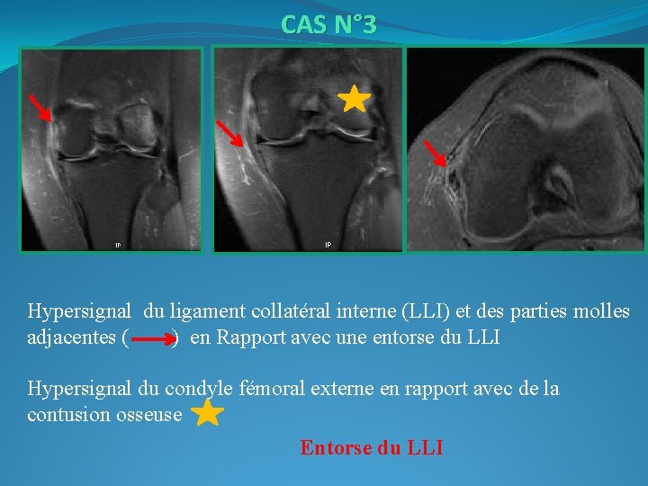 CAS N° 3 Hypersignal du ligament collatéral interne (LLI) et des parties molles adjacentes