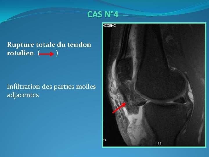 CAS N° 4 Rupture totale du tendon rotulien ( ) Infiltration des parties molles