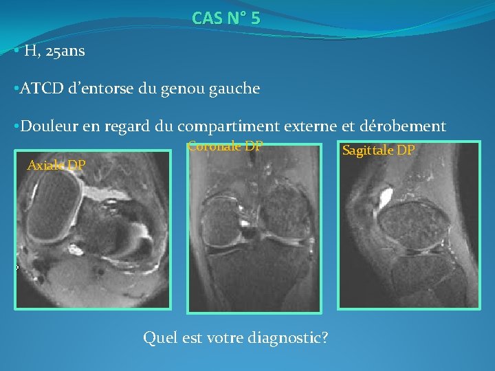  CAS N° 5 • H, 25 ans • ATCD d’entorse du genou gauche