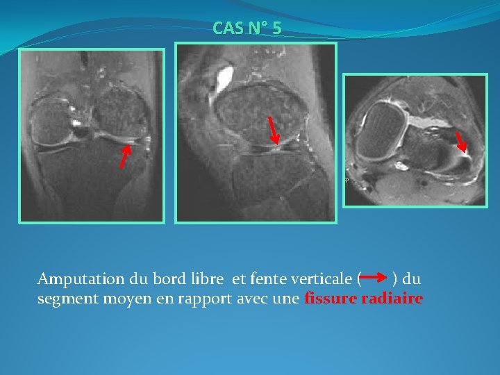  CAS N° 5 Amputation du bord libre et fente verticale ( ) du