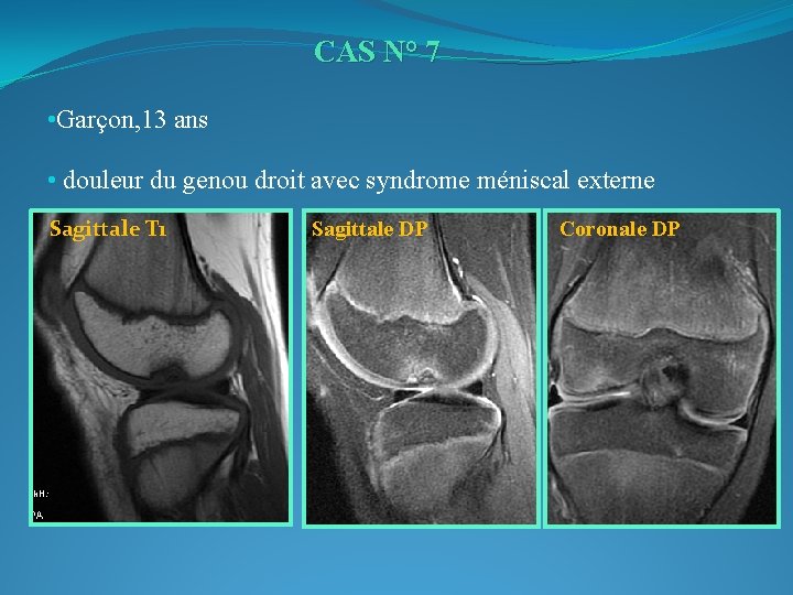CAS N° 7 • Garçon, 13 ans • douleur du genou droit avec syndrome