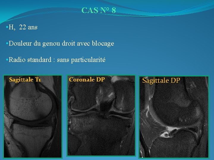 CAS N° 8 • H, 22 ans • Douleur du genou droit avec blocage