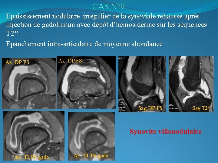 CAS N° 9 Epaississement nodulaire irrégulier de la synoviale rehaussé après injection de gadolinium
