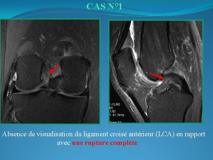 CAS N° 1 Absence de visualisation du ligament croisé antérieur (LCA) en rapport avec