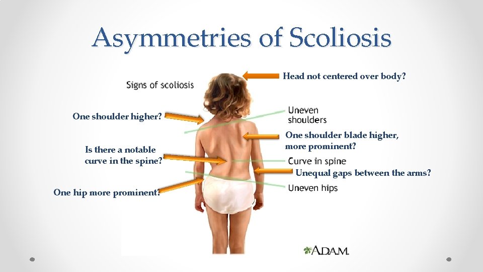 Asymmetries of Scoliosis Head not centered over body? One shoulder higher? Is there a