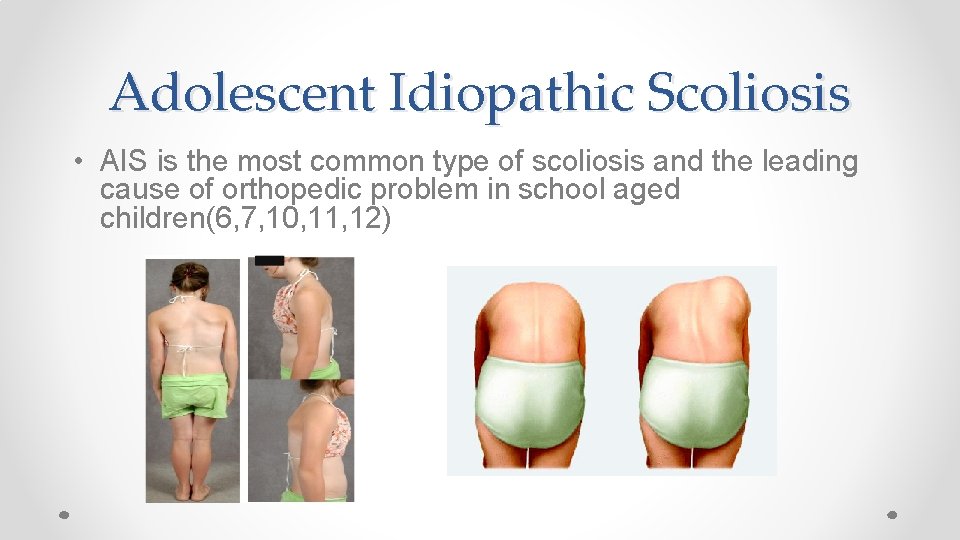Adolescent Idiopathic Scoliosis • AIS is the most common type of scoliosis and the