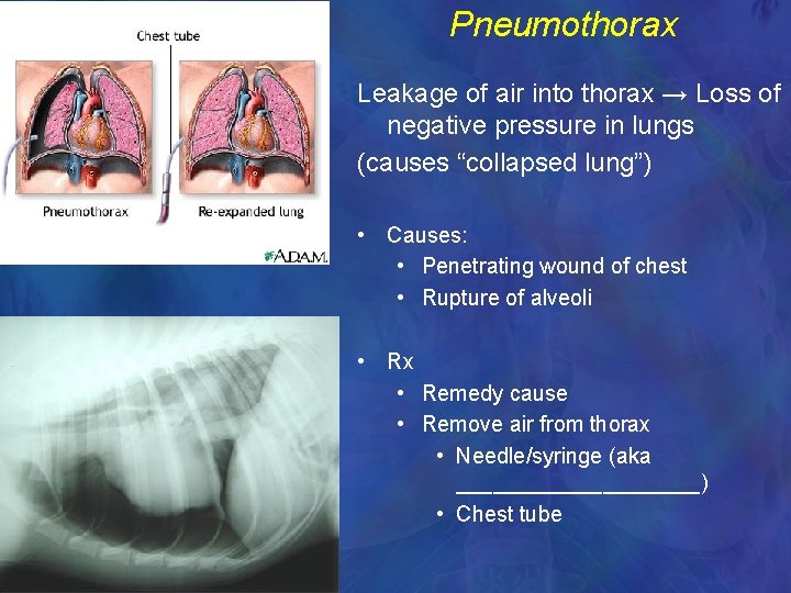 Pneumothorax Leakage of air into thorax → Loss of negative pressure in lungs (causes