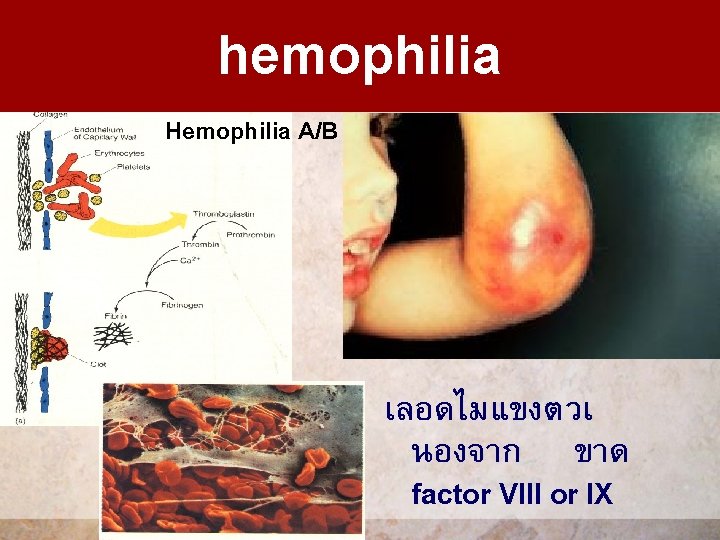 hemophilia Hemophilia A/B เลอดไมแขงตวเ นองจาก ขาด factor VIII or IX 