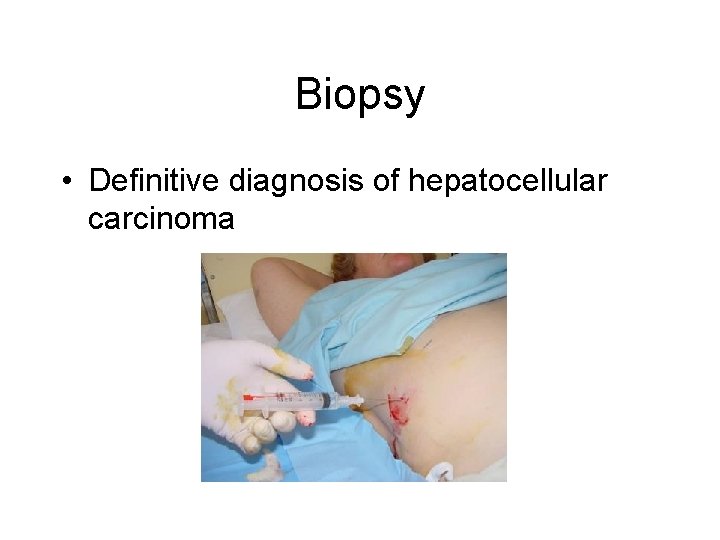 Biopsy • Definitive diagnosis of hepatocellular carcinoma 