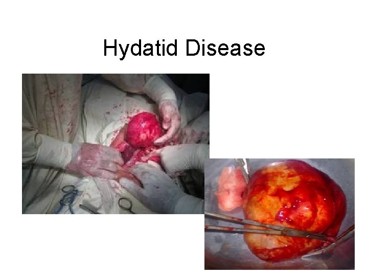 Hydatid Disease 
