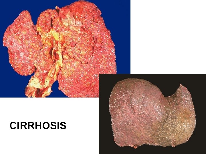 CIRRHOSIS 