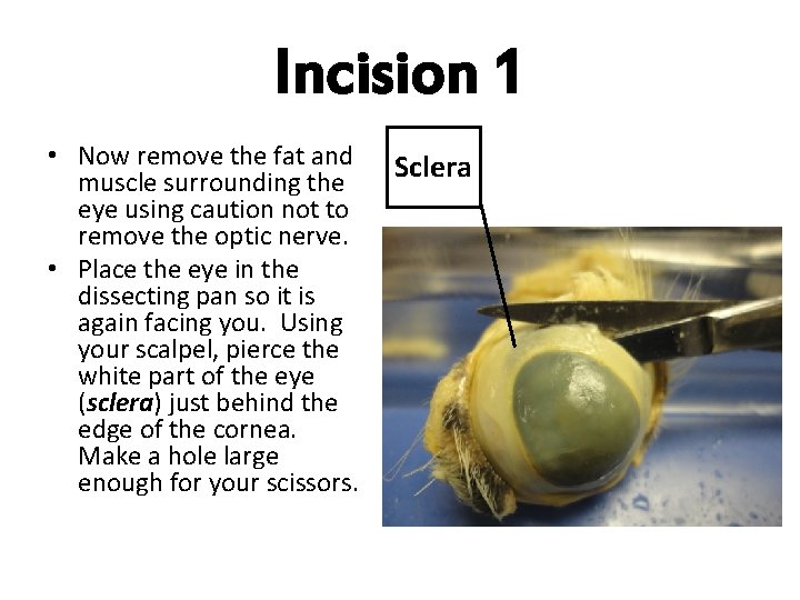 Incision 1 • Now remove the fat and muscle surrounding the eye using caution