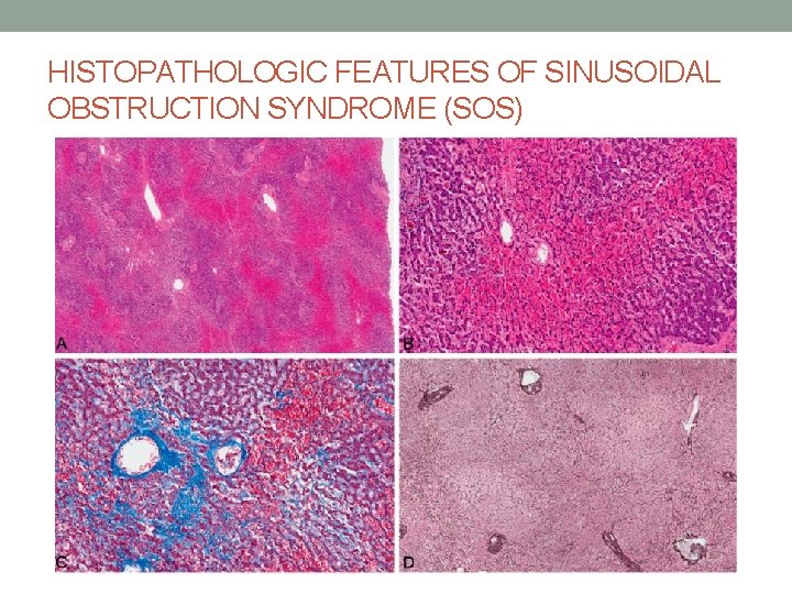 HISTOPATHOLOGIC FEATURES OF SINUSOIDAL OBSTRUCTION SYNDROME (SOS) 