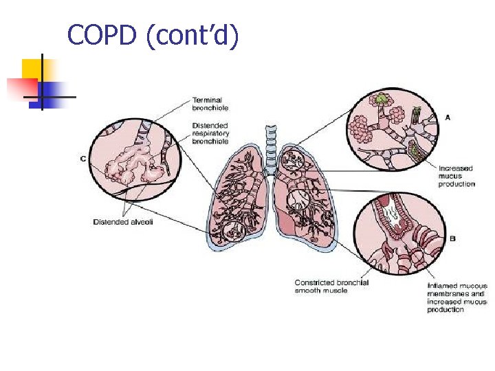 COPD (cont’d) 