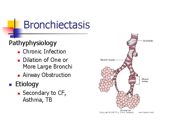 Bronchiectasis Pathyphysiology n n Chronic Infection Dilation of One or More Large Bronchi Airway