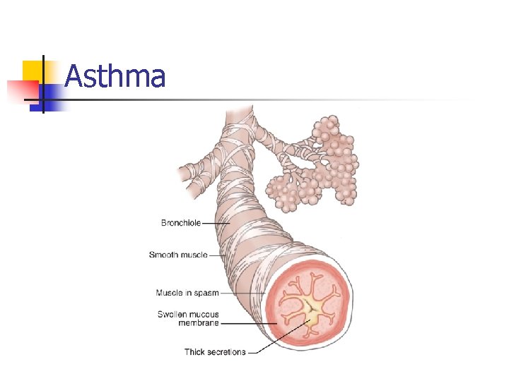 Asthma 