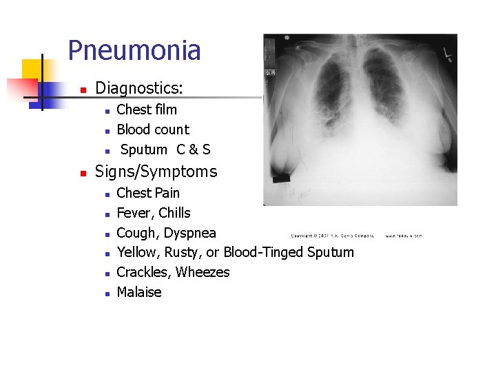 Pneumonia n Diagnostics: n n Chest film Blood count Sputum C & S Signs/Symptoms