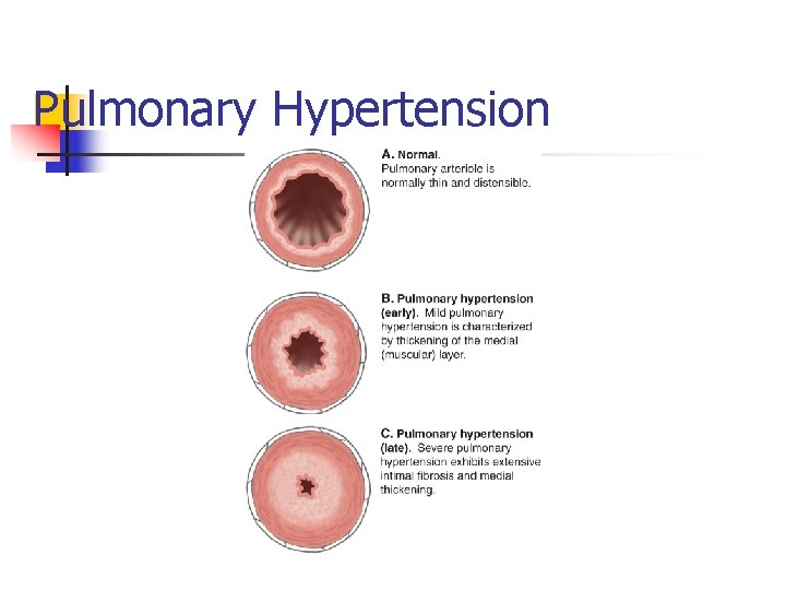 Pulmonary Hypertension 